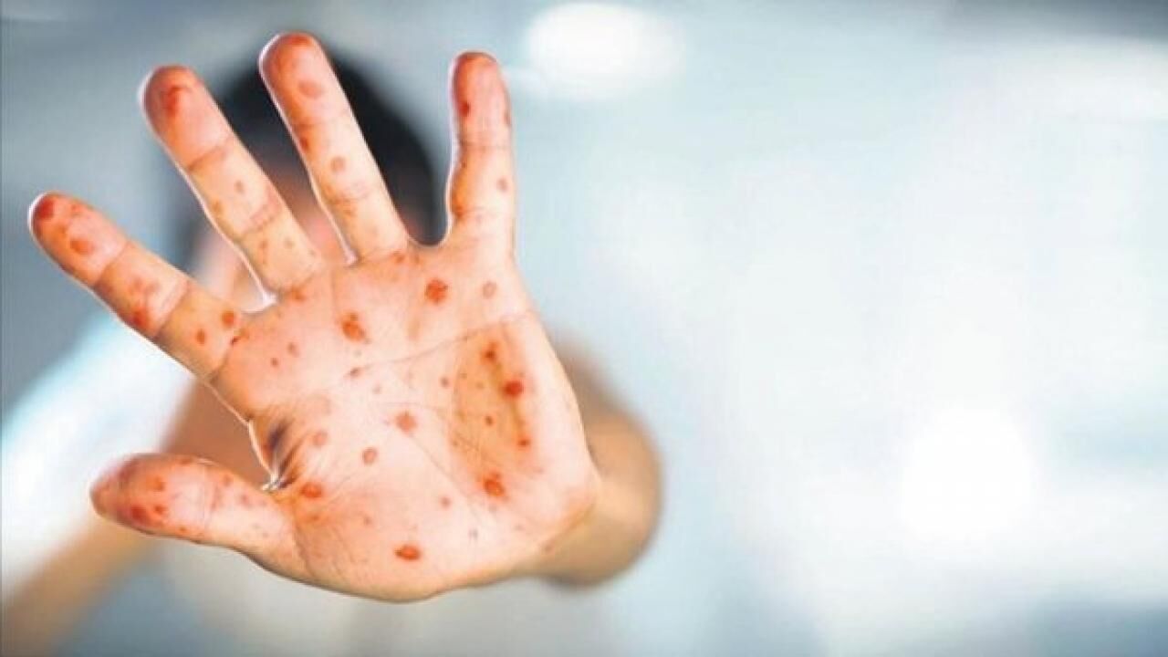 AB ülkelerinde maymun çiçeği vakalarında son rakam