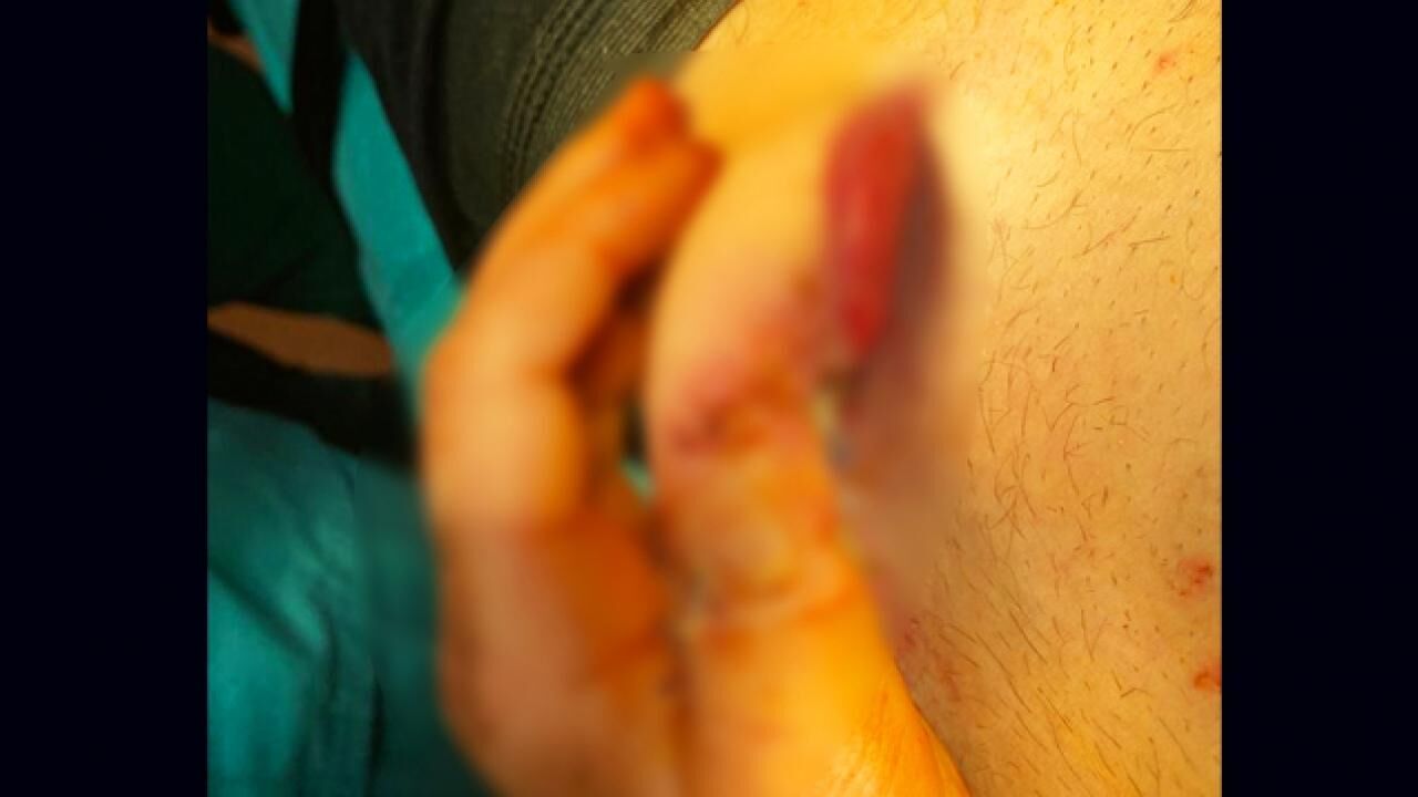 Kazada kopan parmağı, göbeğinde yeniden büyütüldü