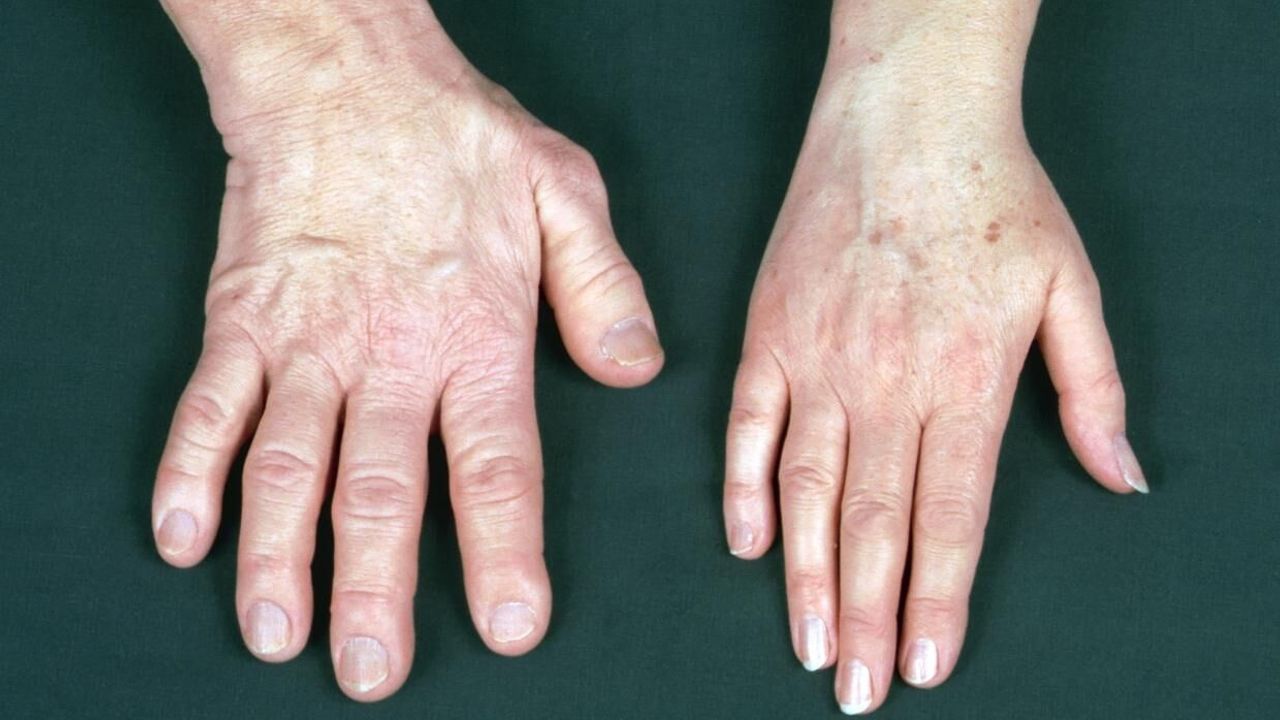 Nadir görülen 'Akromegali' hastalığına dikkat! Büyüme hastalığı olarak biliniyor