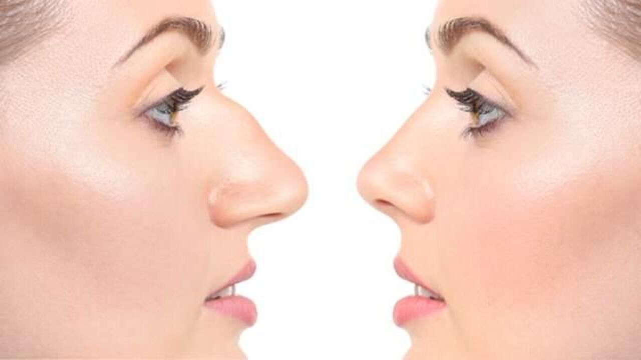 Toplumun yüzde 70-80'inde görülüyor: Burun eğriliği