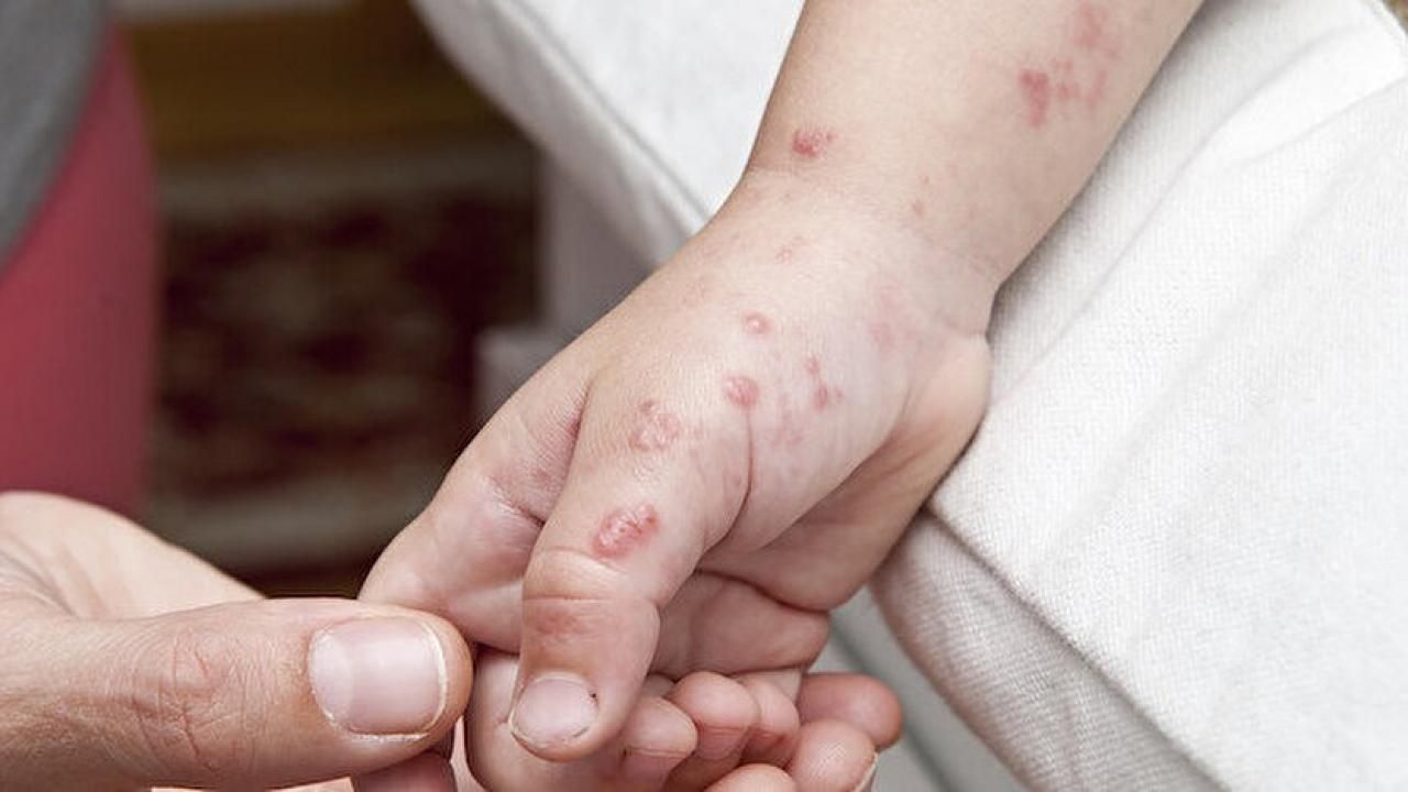 10 soruda 'maymun çiçeği' hastalığı