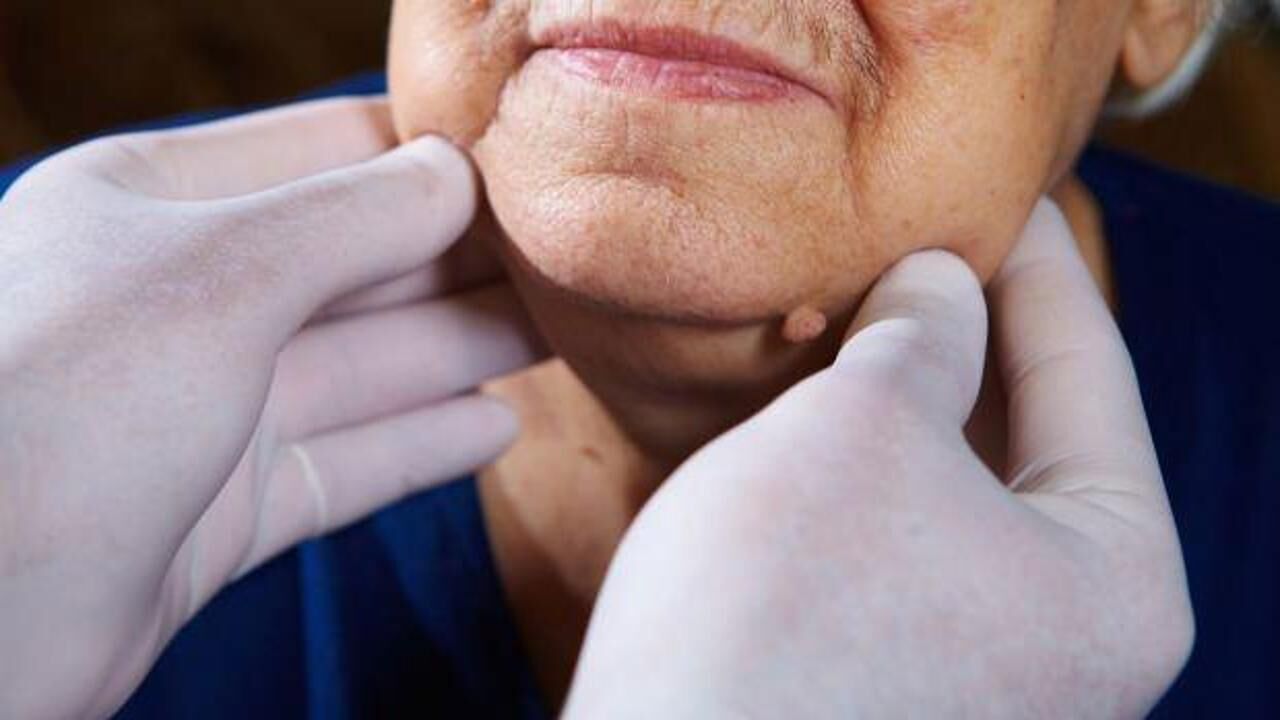 Lenf kanseri nedir, lenfoma kanseri belirtileri nelerdir? Lenf kanseri ölümcül müdür?