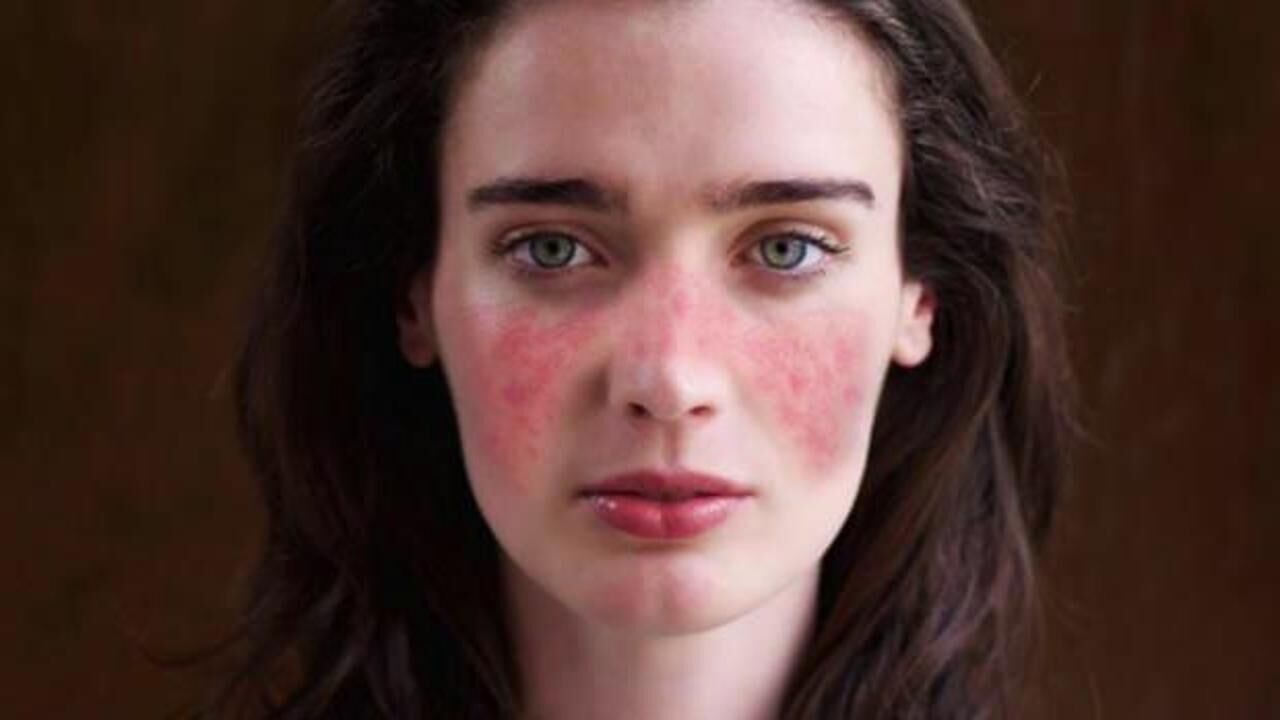 Lupus hastalığı nedir, belirtileri nelerdir? Lupus hastalığı öldürücü müdür, tedavisi nedir?