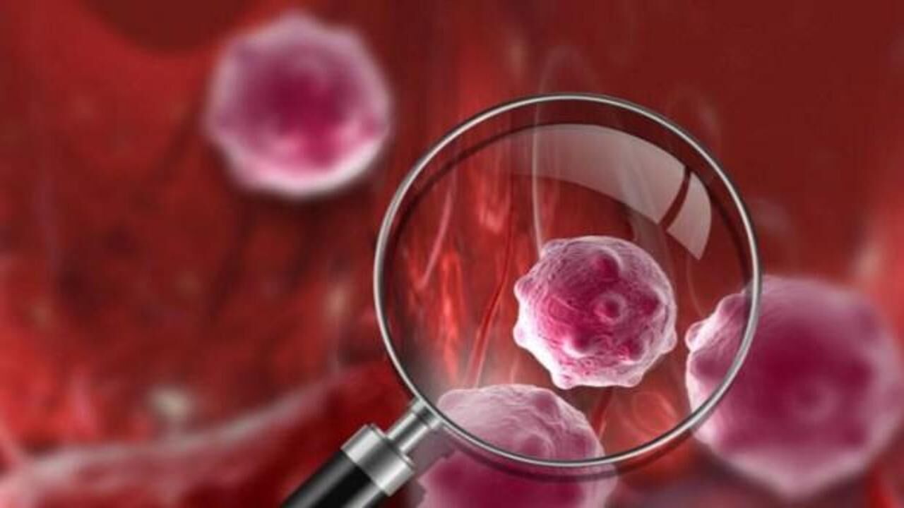 Miyeloid Lösemi nedir? Kronik Miyeloid Löseminin belirtileri