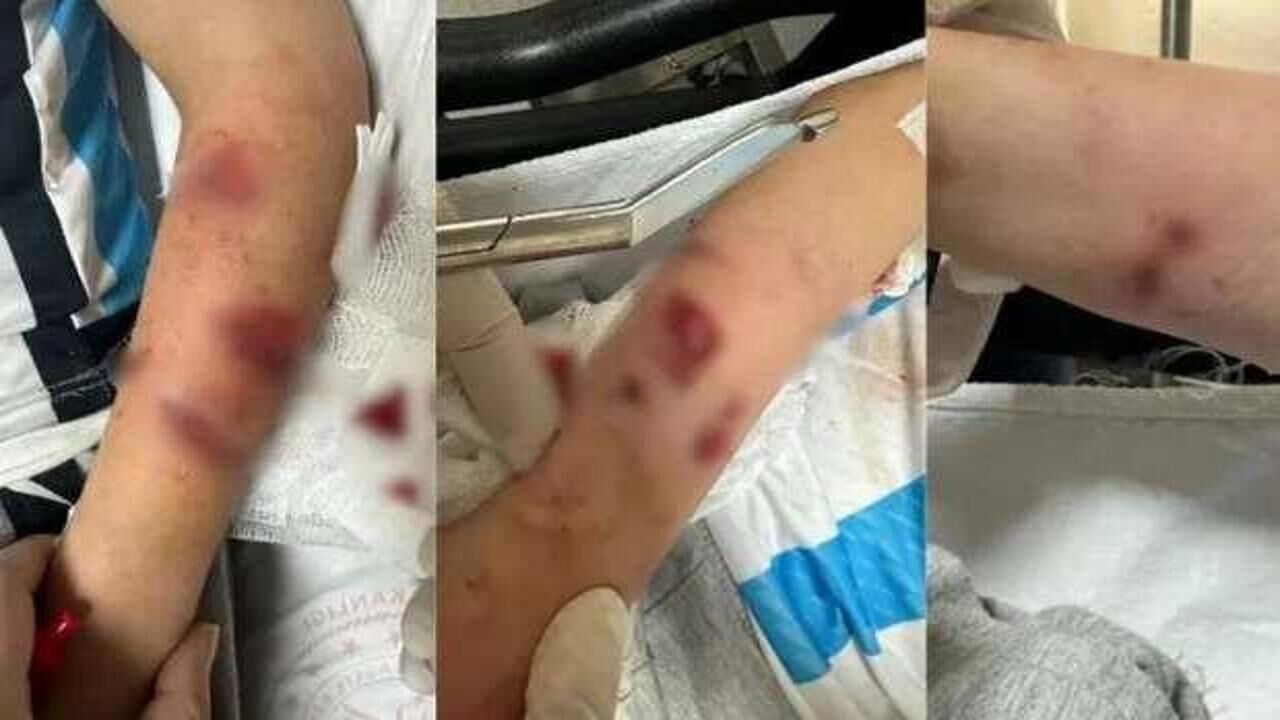 Rize'de sokak köpeklerinin saldırısına uğrayan çocuk yaralandı