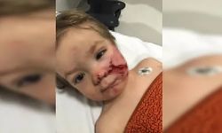 Ankara'da 1,5 ve 5 yaşındaki kardeşler pitbull saldırısına uğradı