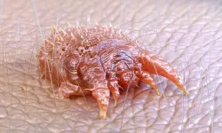 Türk Dermatoloji Derneği’nden ‘Uyuz’ açıklaması