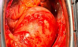 Van’da Tıp Tarihine Geçen Başarı: Tüm Aort Damarı Değiştirildi