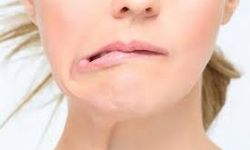 "Yüz felcinde erken müdahale kalıcı hasarı önlüyor"