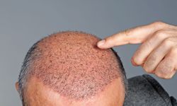 Van’da saç ekimi yapmayı düşünenlere uyarı! Ruhsatlı sadece 2 merkez var