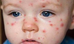 Suçiçeği alarmı! "İlk defa böyle bir sıklık görüyoruz"