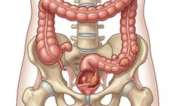 Van'da uzman uyarısı: “Kolorektal kanser taramasını aksatmayın"