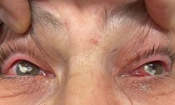 Gözlerine kırlangıç otu suyunu damlattı, göremez hale geldi