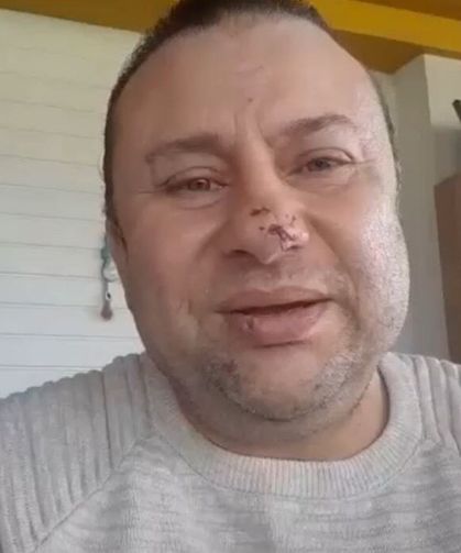 Pitbull saldırısına uğrayan Onur Akay o anları anlattı