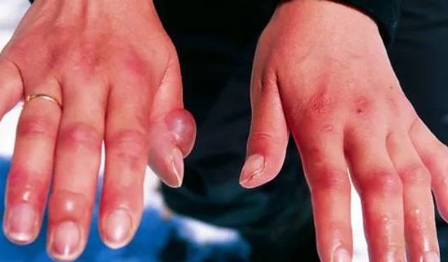 Kışın korkusu: "Soğuk ısırması"