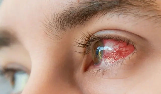 Kış ayında göz enfeksiyonlarına dikkat!