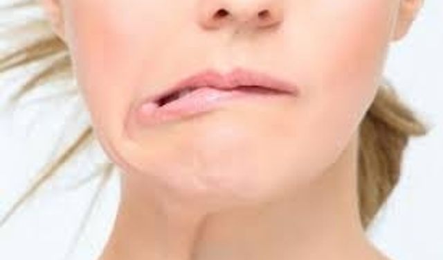 "Yüz felcinde erken müdahale kalıcı hasarı önlüyor"