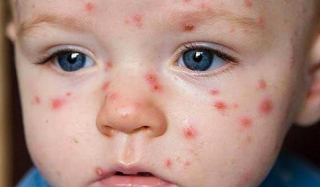 Suçiçeği alarmı! "İlk defa böyle bir sıklık görüyoruz"