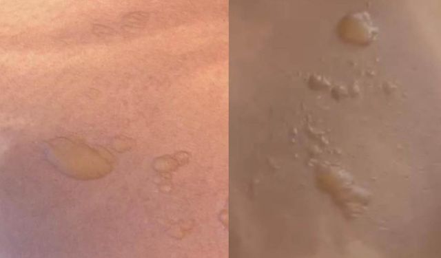 Sıcak su torbası tehlikesi yeniden gündemde: “3 dakika sonra patladı”