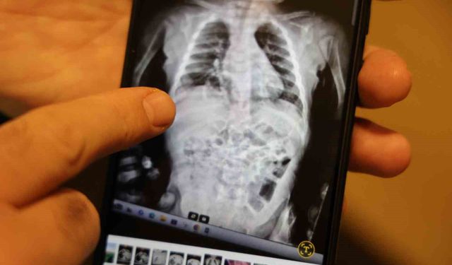 200 binde bir görülen hastalıkla 2 yıl boyunca yaşayan çocuk sağlığına kavuştu