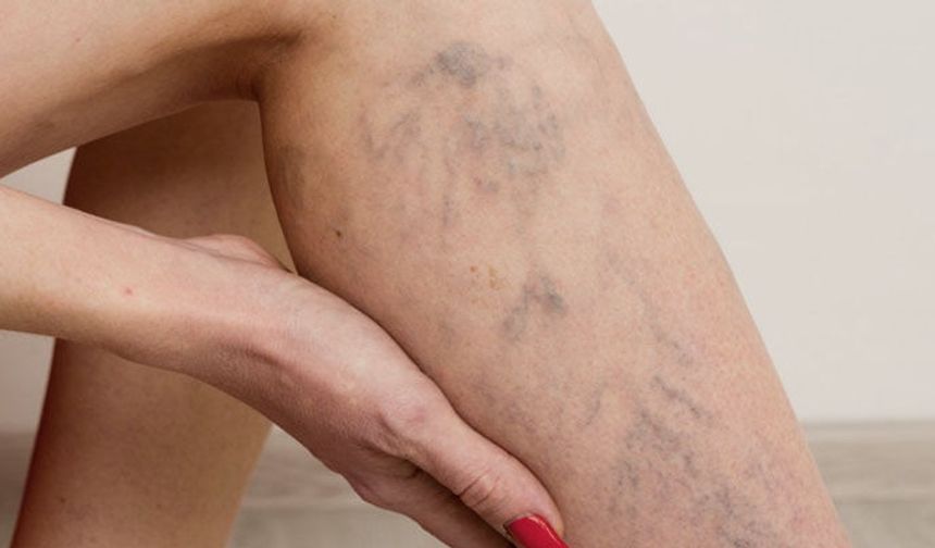 Dikkat! Varisle karıştırılan ödem farklı hastalıkların habercisi olabilir