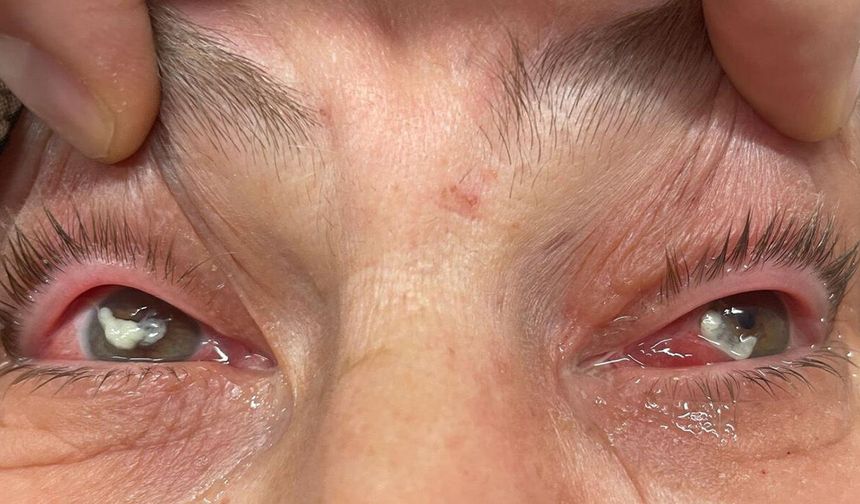 Gözlerine kırlangıç otu suyunu damlattı, göremez hale geldi