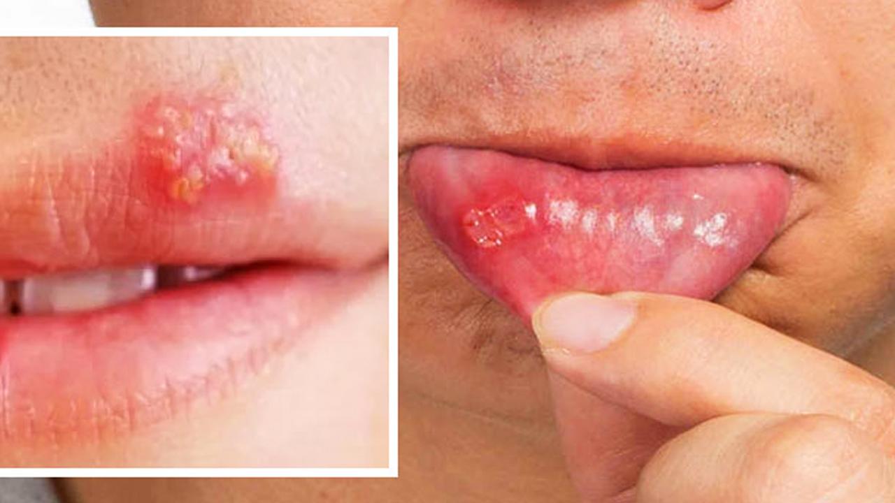 Dudakta uçuk neden çıkar? Tekrarlayan uçuk nasıl geçer?