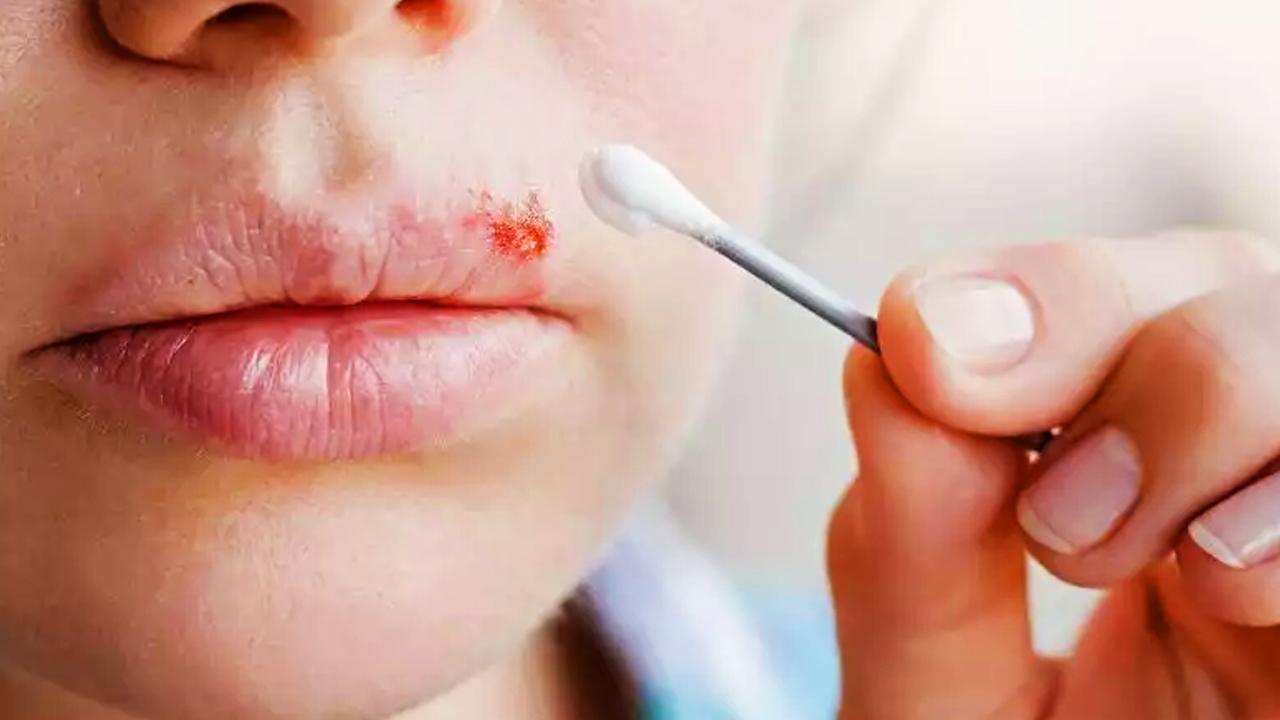 Dudakta uçuk neden çıkar? Tekrarlayan uçuk nasıl geçer?