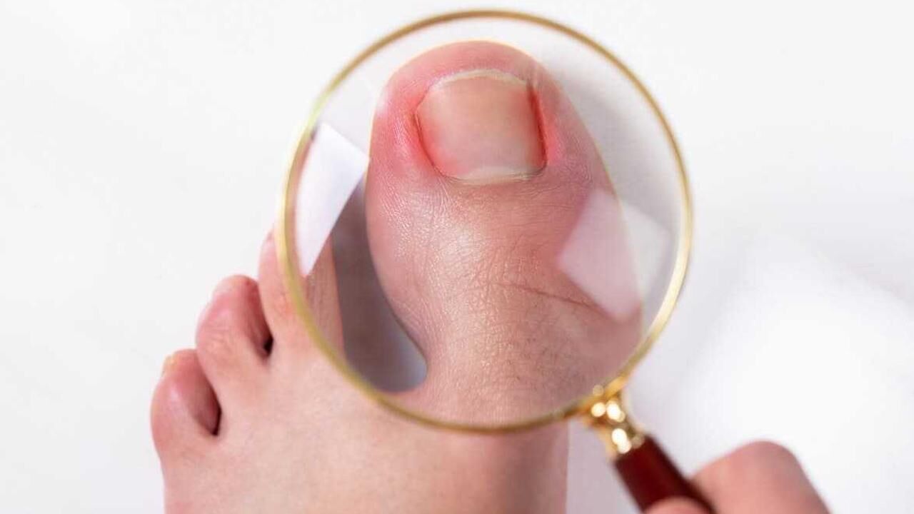 Ayak tırnak batması nasıl geçer? Geçmeyen tırnak batması neden olur?