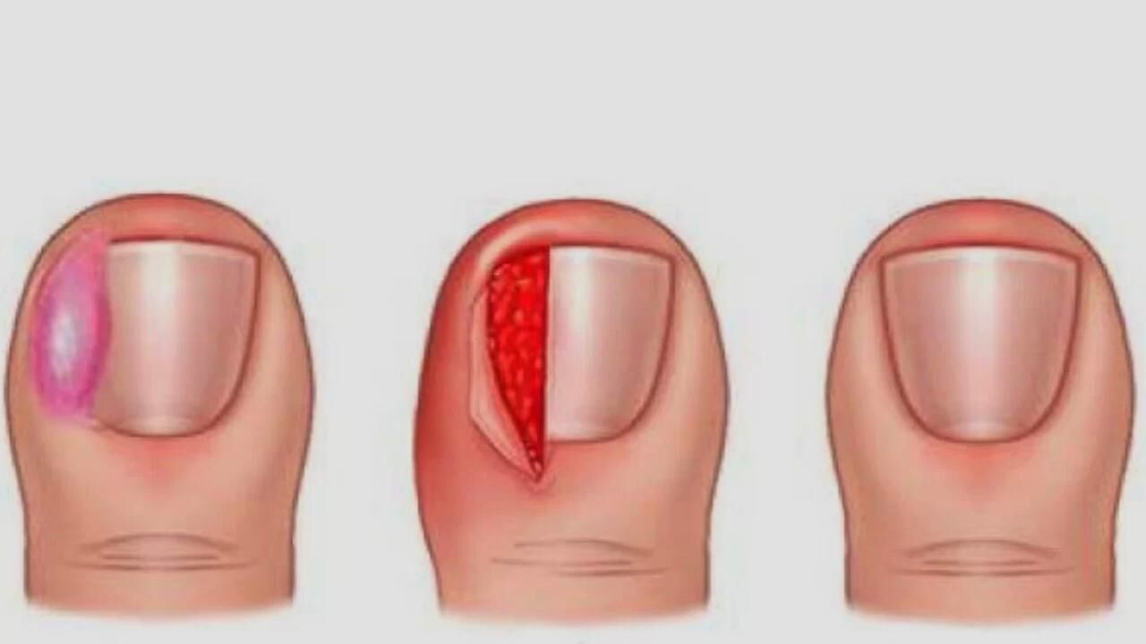 Ayak tırnak batması nasıl geçer? Geçmeyen tırnak batması neden olur?