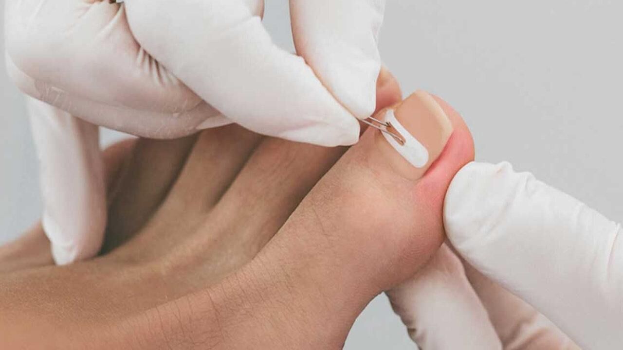 Ayak tırnak batması nasıl geçer? Geçmeyen tırnak batması neden olur?