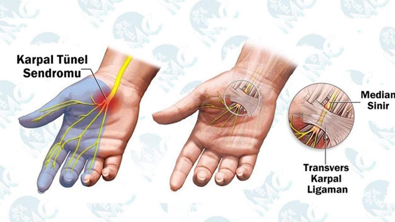 Karpal tünel sendromu nedir, neden olur? Karpal tünel sendromu belirtileri ve tedavisi…