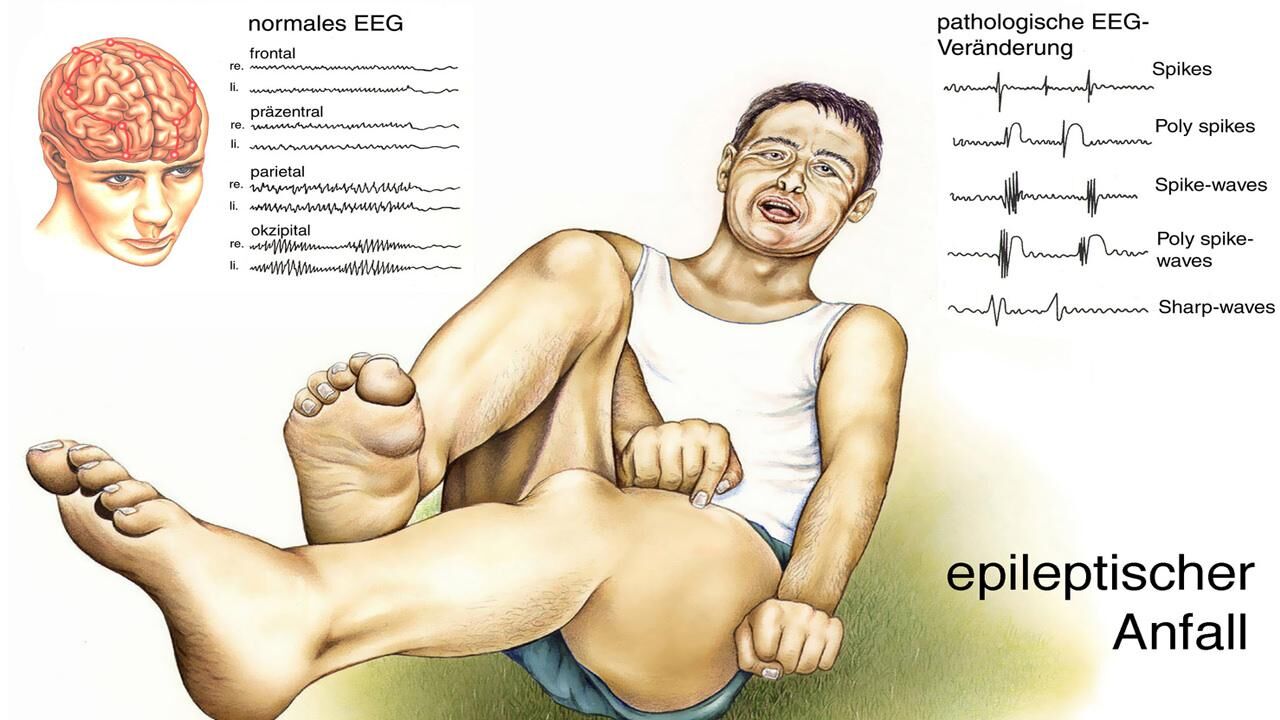 Epilepsi nedir, belirtileri nelerdir? Epilepsi neden olur, öldürür mü?