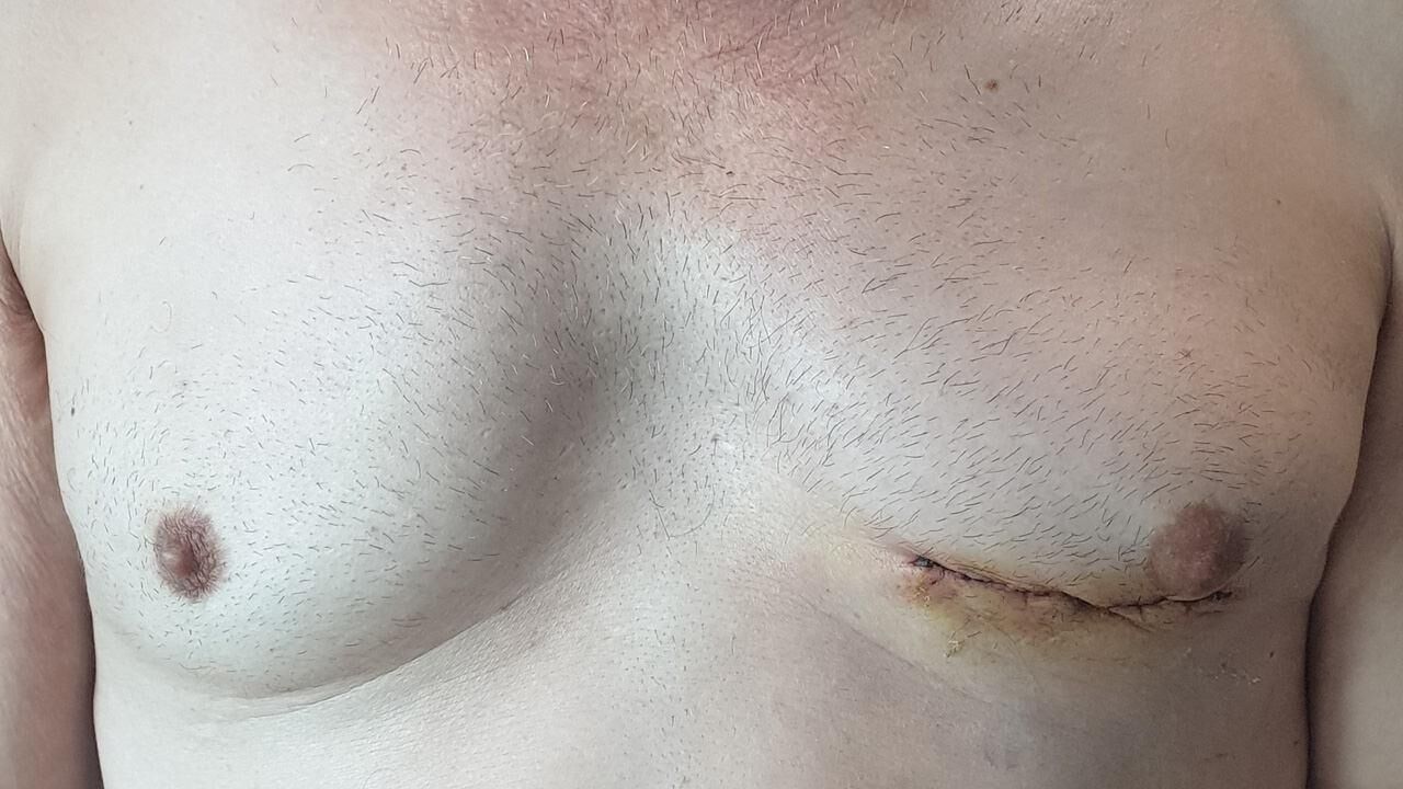 Kalp ameliyatları kabus olmaktan çıkıyor! Küçük kesi kalp cerrahi mucizesi…