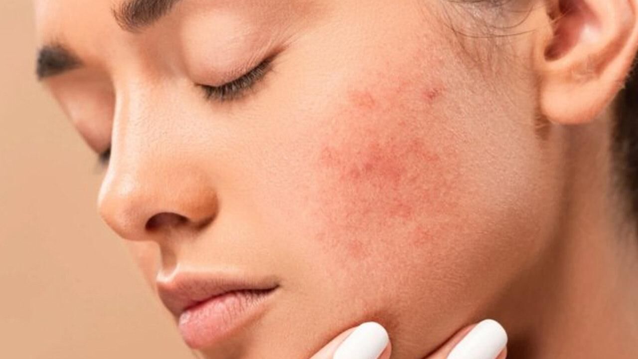 Güneş alerjisine ne iyi gelir, nasıl geçer? Güneş alerjisi belirtileri nelerdir?