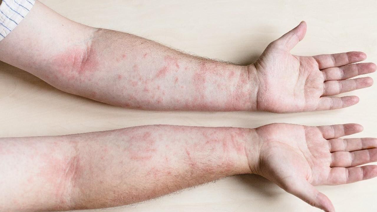 Güneş alerjisine ne iyi gelir, nasıl geçer? Güneş alerjisi belirtileri nelerdir?