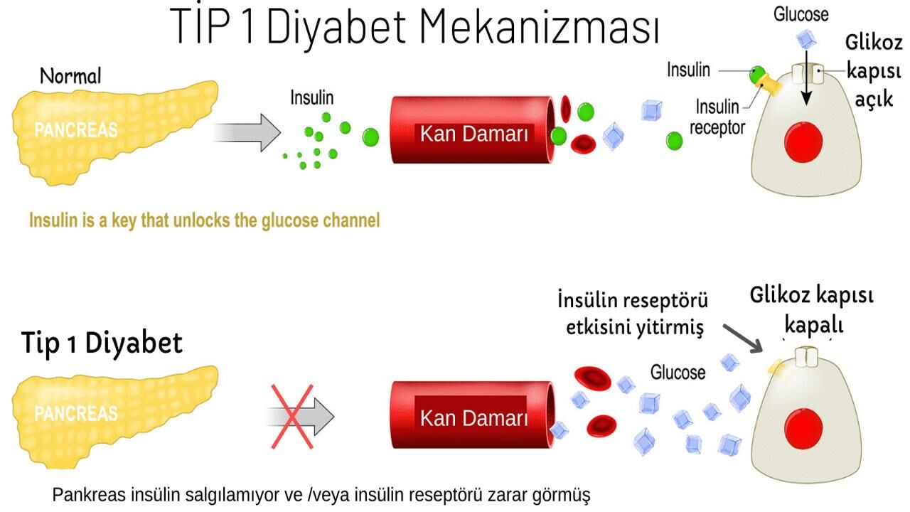Tip 1 diyabet nedir, belirtileri nelerdir? Diyabet tip 1 geçer mi, tedavisi nedir?