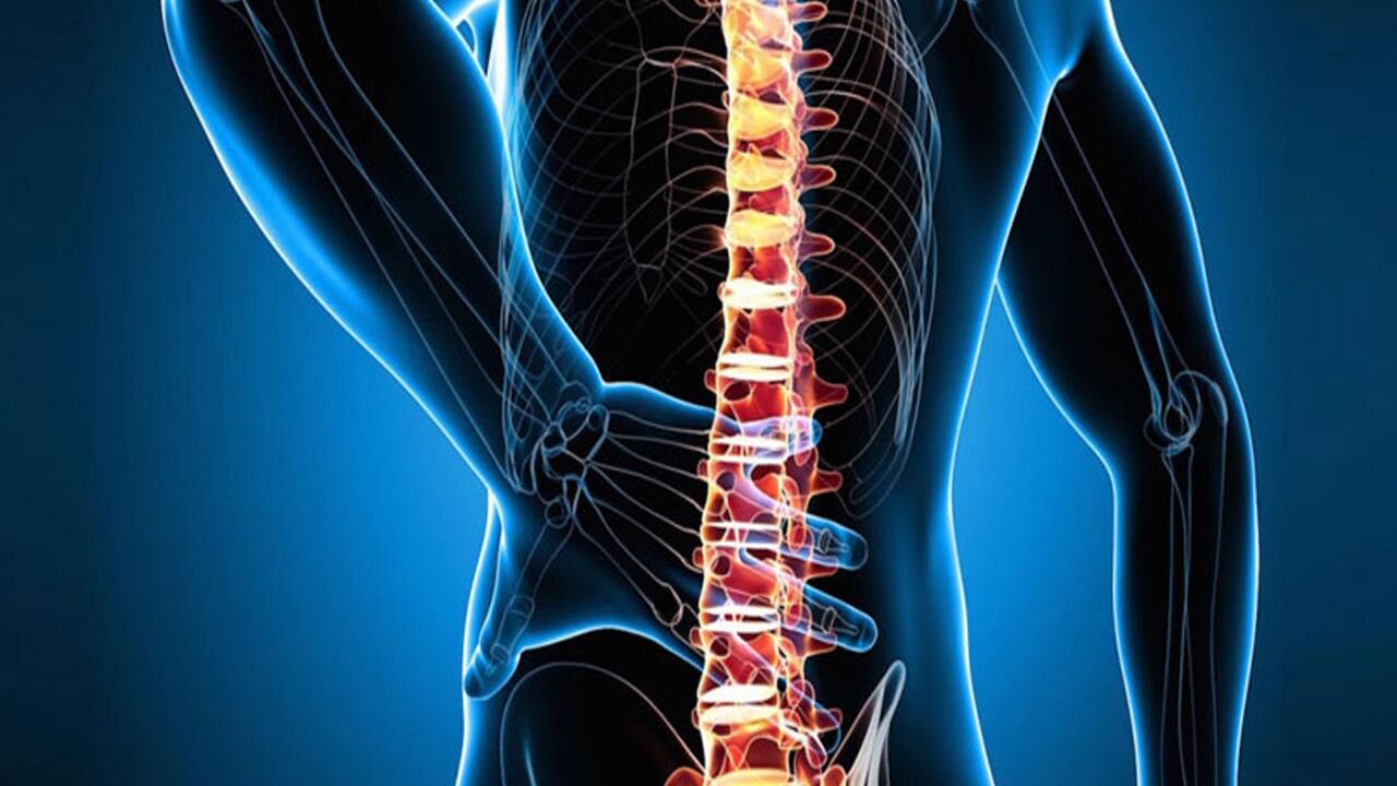 Skolyoz nedir,  tedavisi var mı? Skolyoz hastalarının görüntüsü...