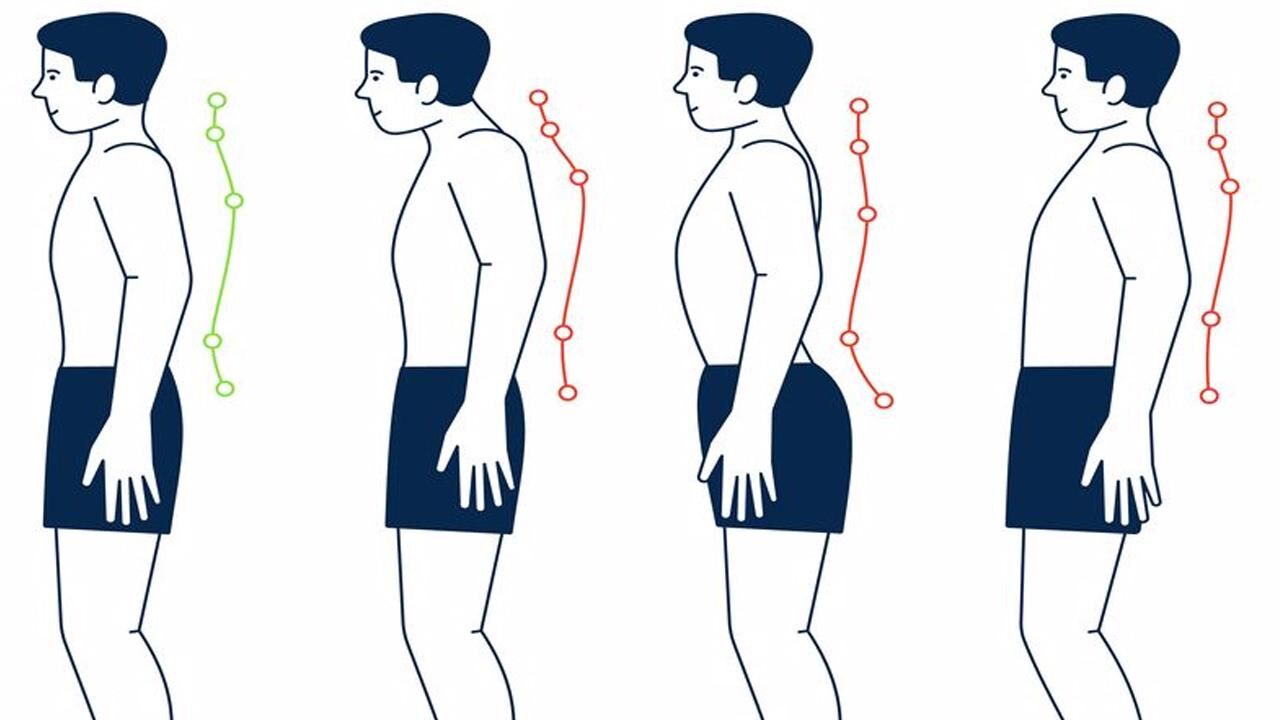 Skolyoz nedir,  tedavisi var mı? Skolyoz hastalarının görüntüsü...