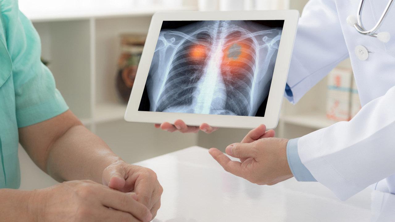 Akciğer zarı kanseri mezotelyoma nedir? Mezotelyoma yaşam süresi…