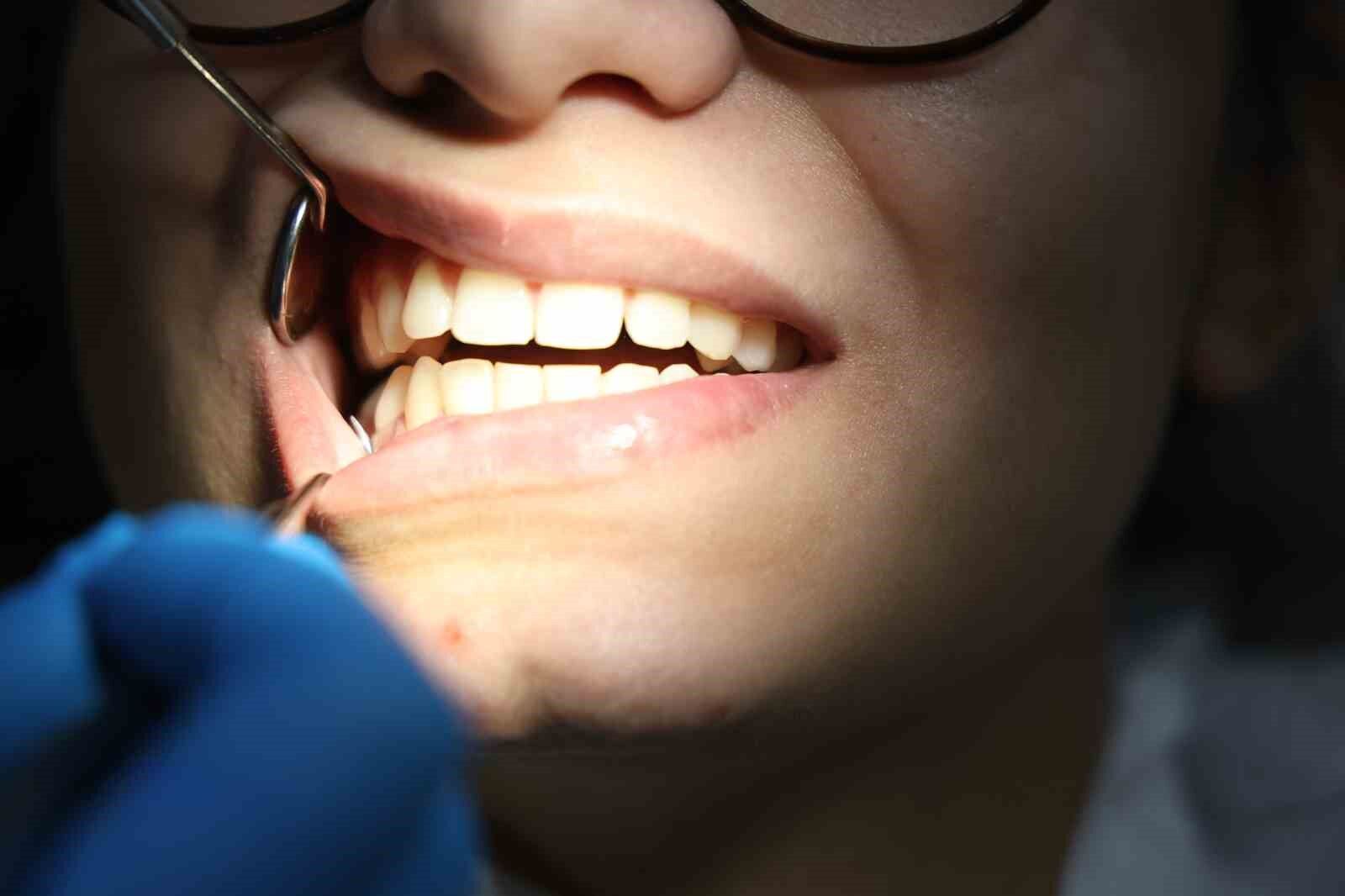 Diş hekimi Yüksel: ’’Diş gıcırdatmanın yüzde 90’ı strese bağlı olarak ortaya çıkıyor’’