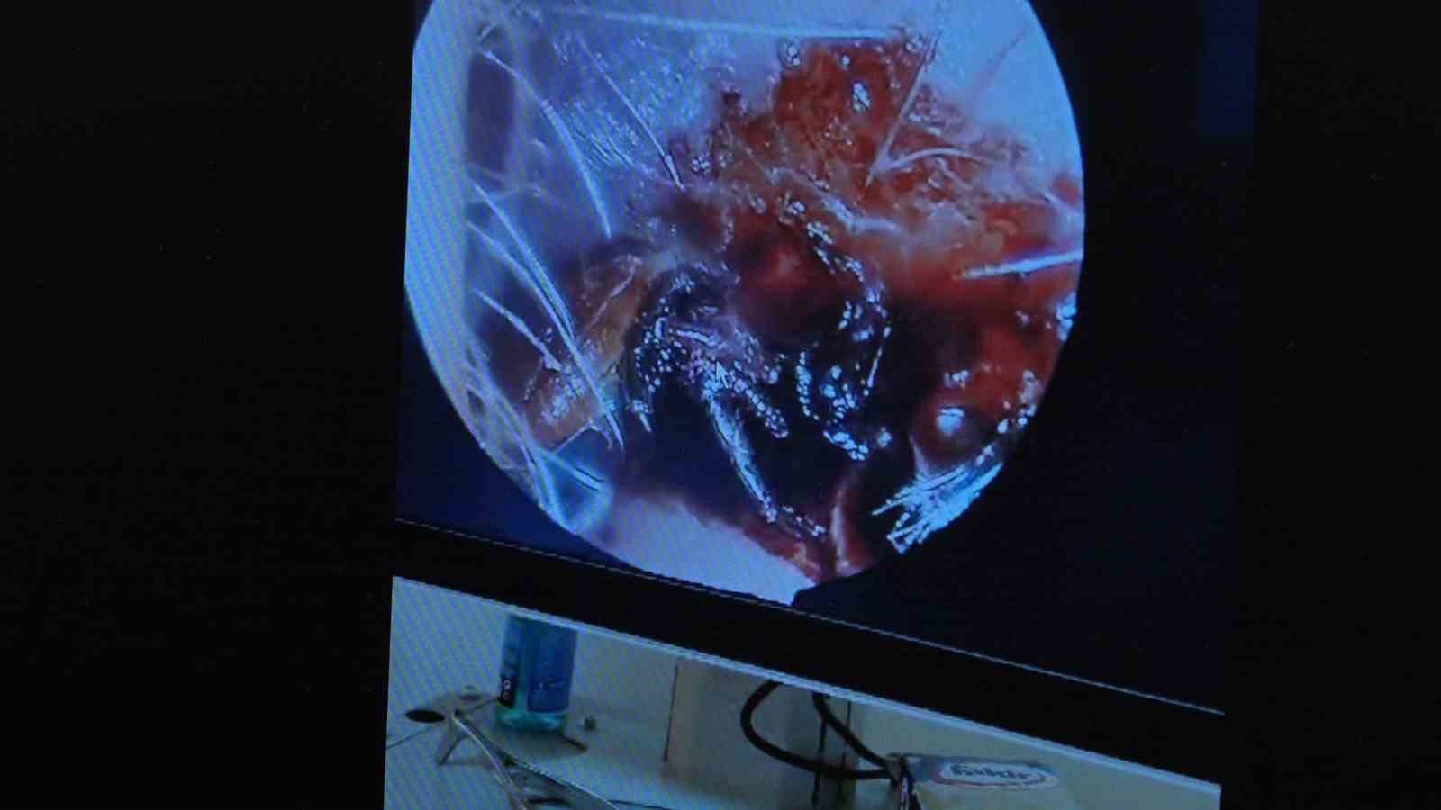 70 yaşındaki kadının kulağında hareket eden kene operasyonla çıkarıldı