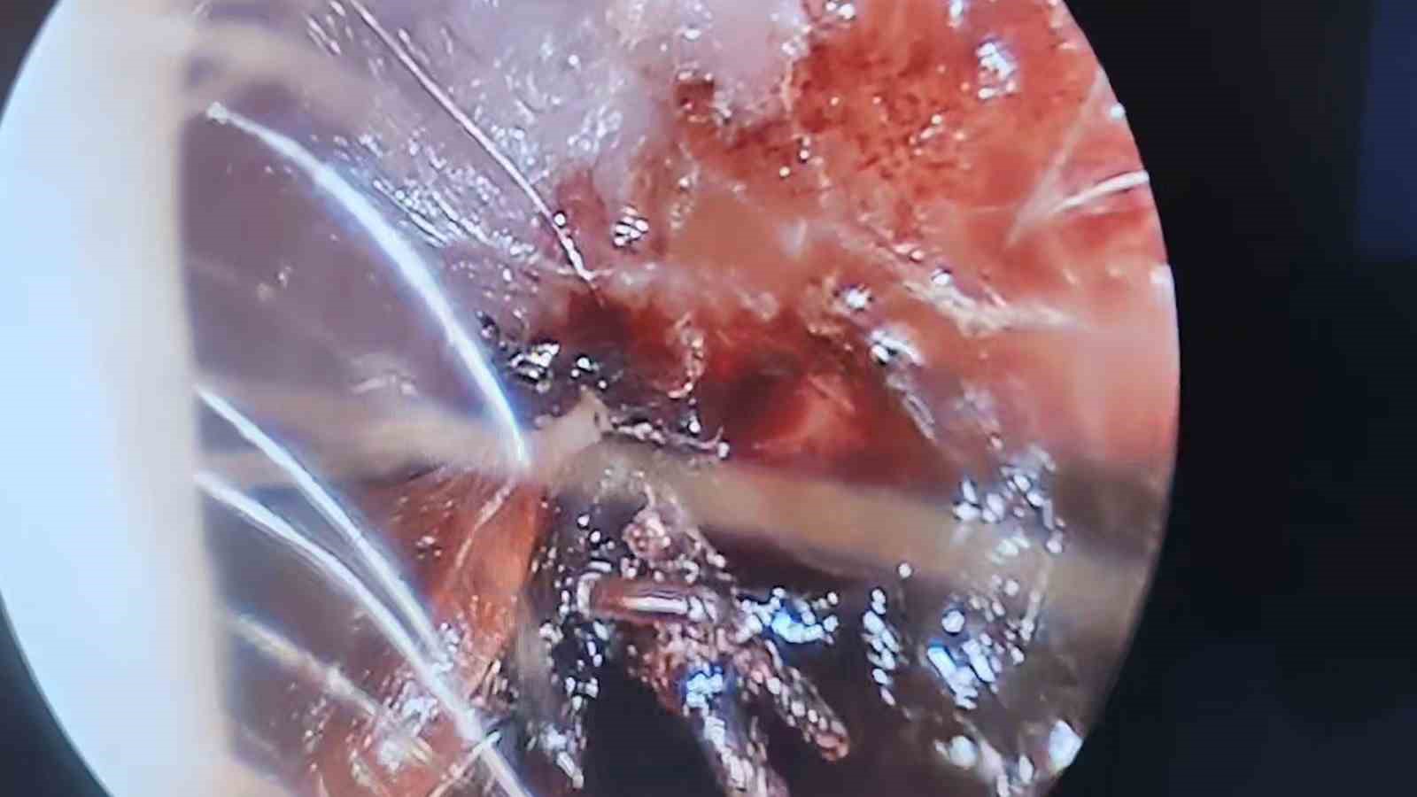 70 yaşındaki kadının kulağında hareket eden kene operasyonla çıkarıldı