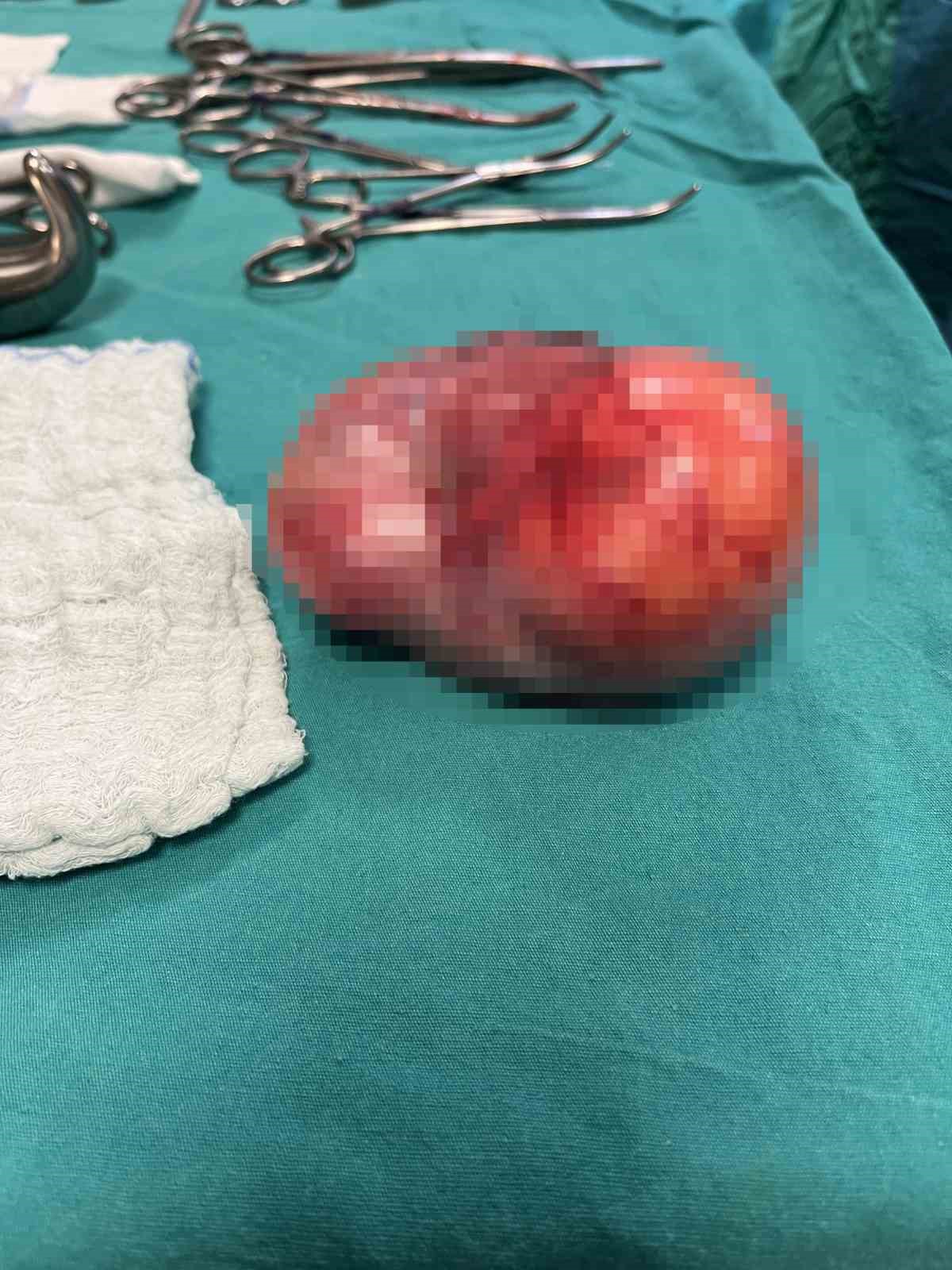 Bitlis’te 16 haftalık 26 yaşındaki gebe hastaya ‘Over Kist’ ameliyatı yapıldı