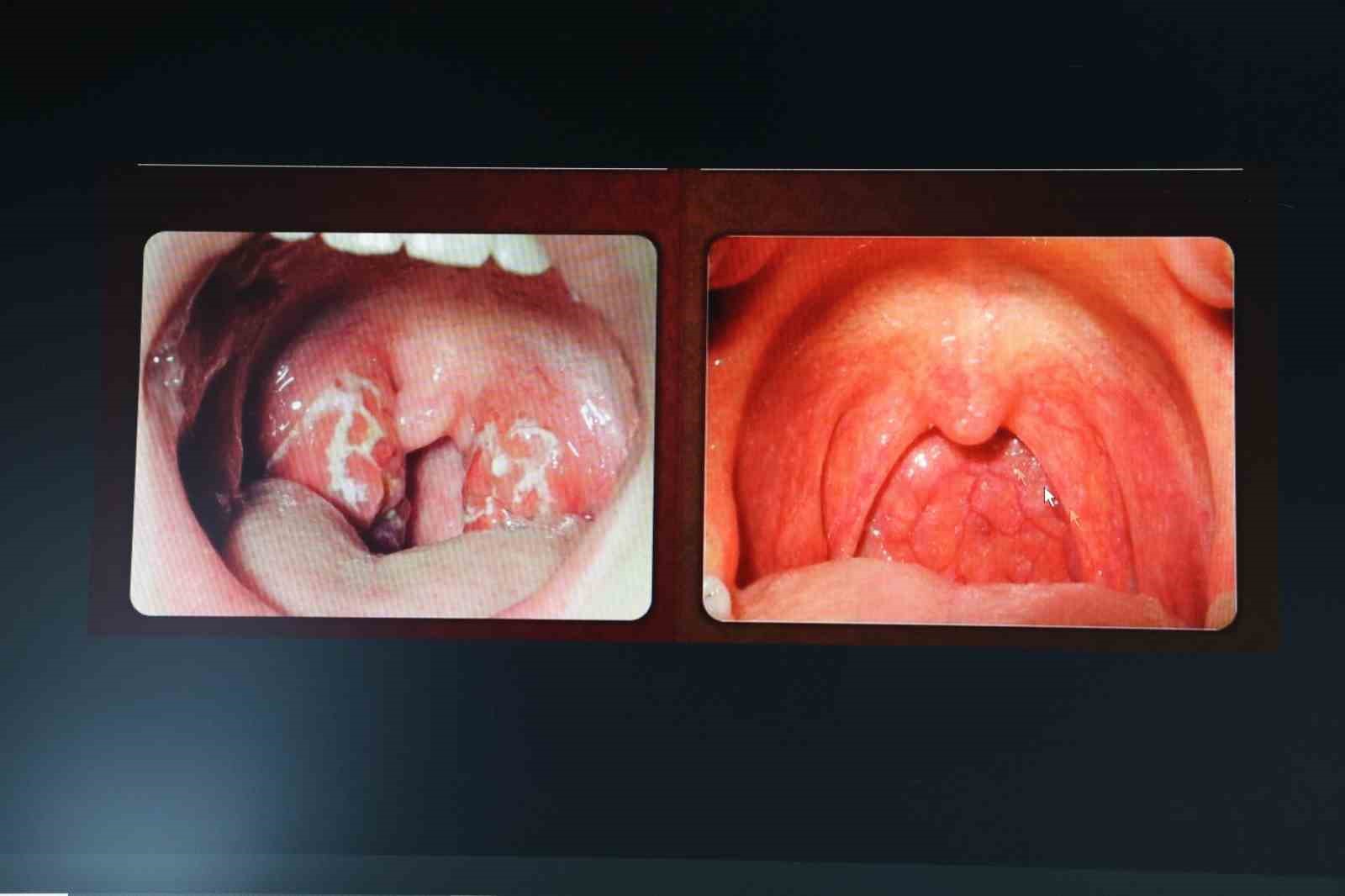 KBB Uzmanı Op. Dr. Özer: ’’Kronik farenjit, özellikle yaz aylarında problem oluşturuyor’’