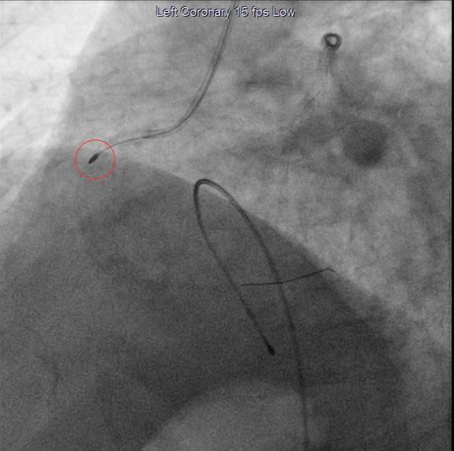 Kireçleşmiş damar tıkanıklıklarına rotablasyon tedavisi