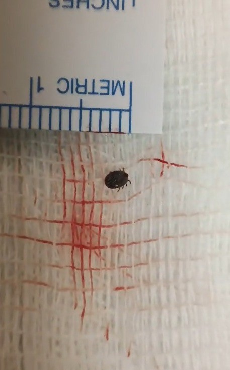 Hastanın gözünde canlı kene çıktı