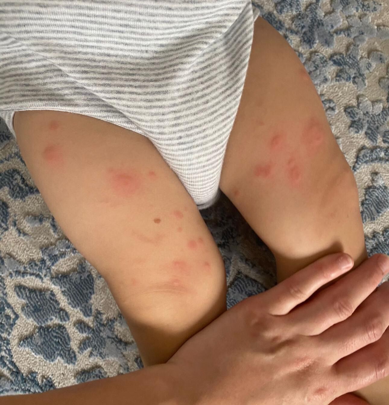 Çocuklarda besin alerjilerine dikkat: 