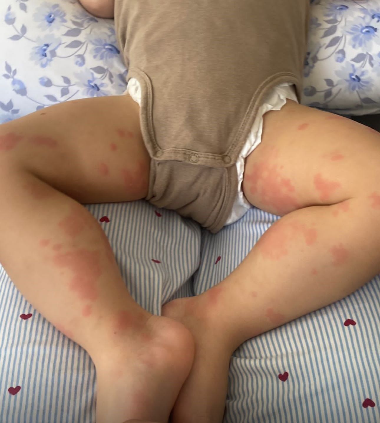 Çocuklarda besin alerjilerine dikkat: 