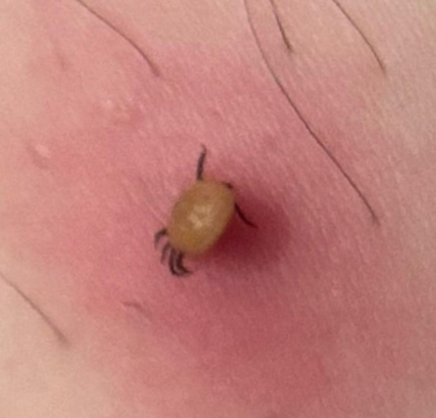 Kene ne kadar erken çıkarılırsa hastalık riski o kadar azalır